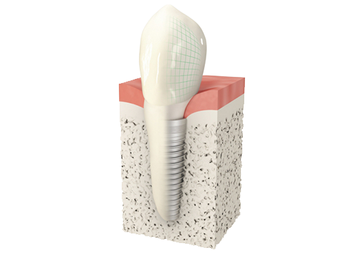 Dentalni implantati