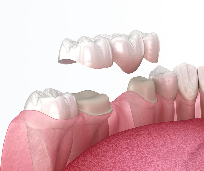 Ponte sui denti naturali