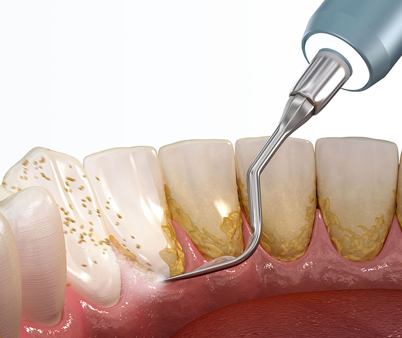 Pulizia della placca dentale e del tartaro