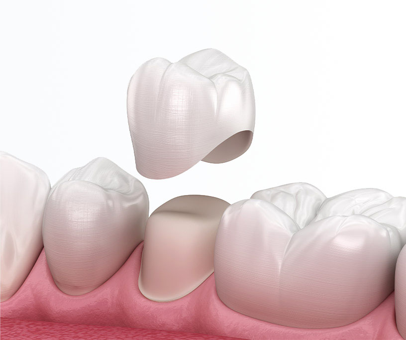Corona sul dente naturale
